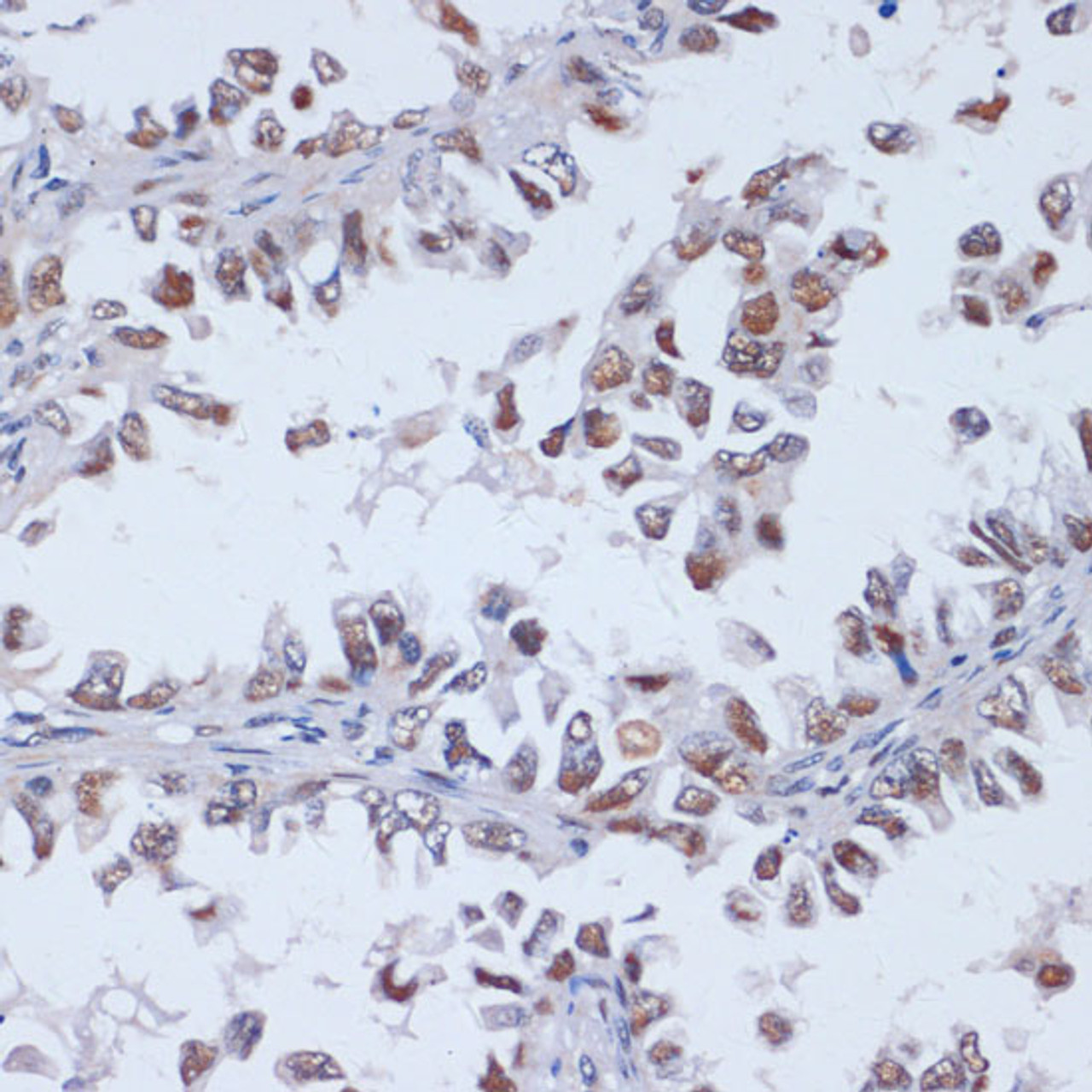 Immunohistochemistry of paraffin-embedded Human lung cancer using DNMT3L Polyclonal Antibody at dilution of  1:100 (40x lens).