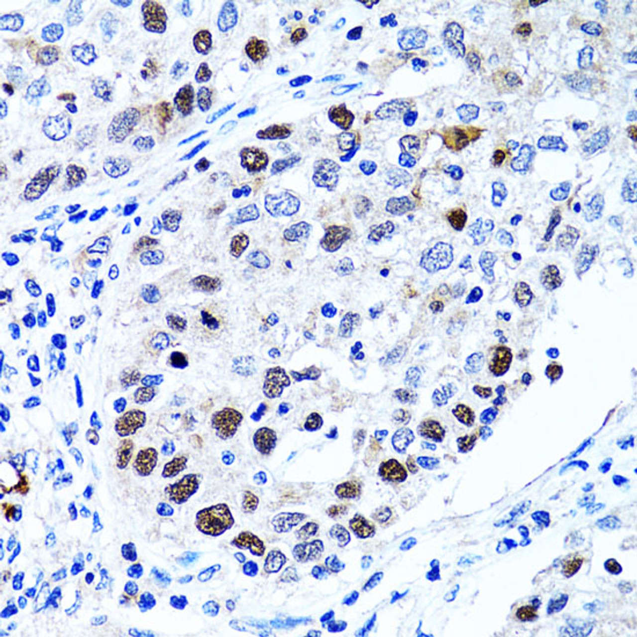 Immunohistochemistry of paraffin-embedded Human lung cancer using UHRF1 Polyclonal Antibody at dilution of  1:100 (40x lens).