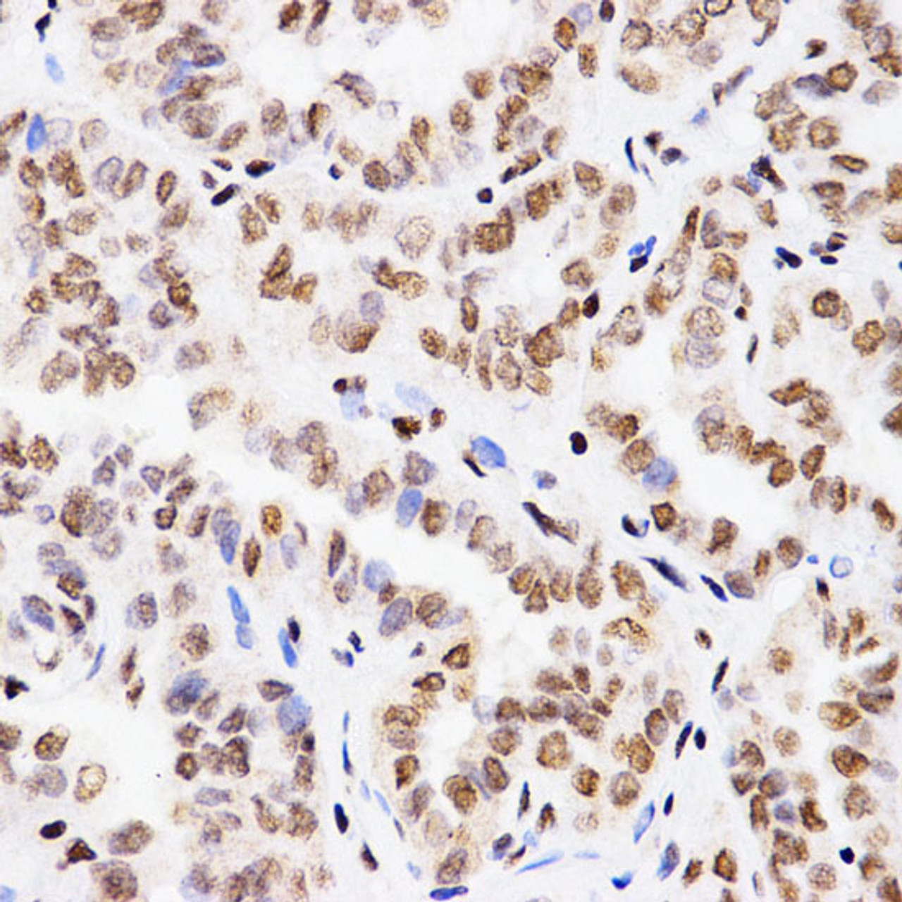 Immunohistochemistry of paraffin-embedded Human thyroid cancer using MonoMethyl-Histone H3-K4 Polyclonal Antibody at dilution of  1:200 (40x lens).