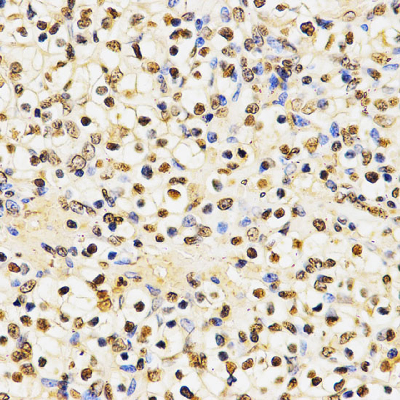 Immunohistochemistry of paraffin-embedded Human kidney cancer using MonoMethyl-Histone H3-K27 Polyclonal Antibody at dilution of  1:200 (40x lens).