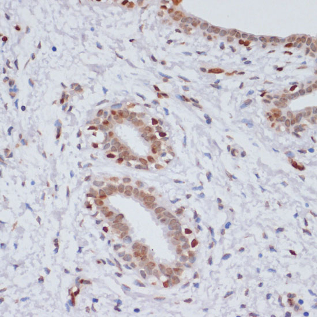 Immunohistochemistry of paraffin-embedded Human breast cancer using TriMethyl-Histone H3-K27 Polyclonal Antibody at dilution of  1:100 (40x lens).