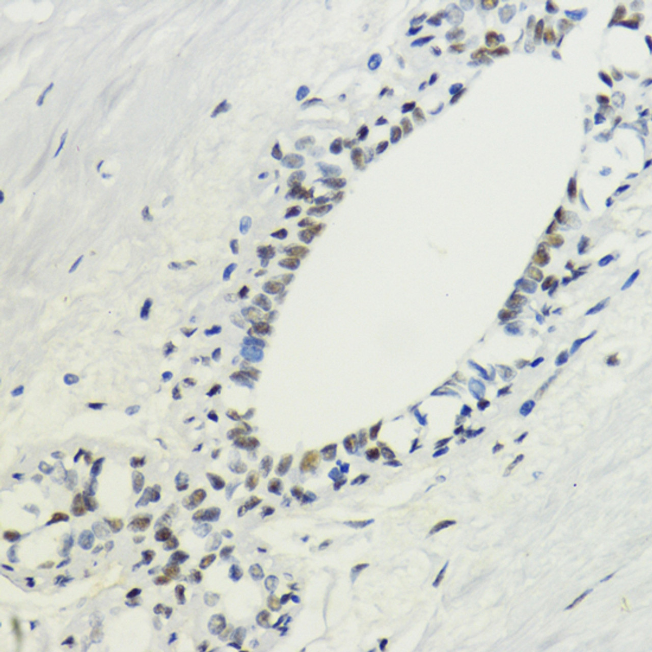 Immunohistochemistry of paraffin-embedded Human breast using TriMethyl-Histone H3-K36 Polyclonal Antibody at dilution of  1:200 (40x lens).