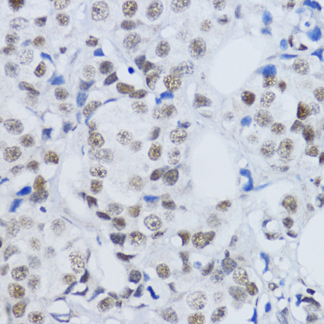 Immunohistochemistry of paraffin-embedded Human mammary cancer using DiMethyl-Histone H3-K79 Polyclonal Antibody at dilution of  1:200 (40x lens).