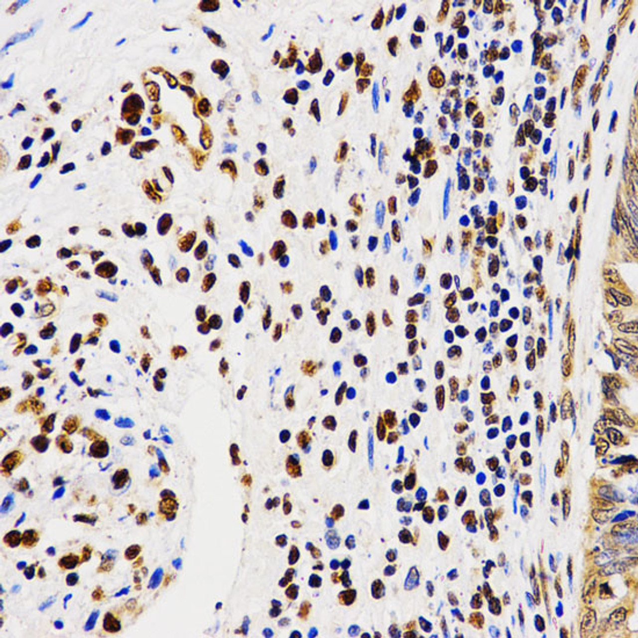 Immunohistochemistry of paraffin-embedded Human rectal cancer using Asymmetric DiMethyl-Histone H4-R3 Polyclonal Antibody at dilution of  1:200 (40x lens).