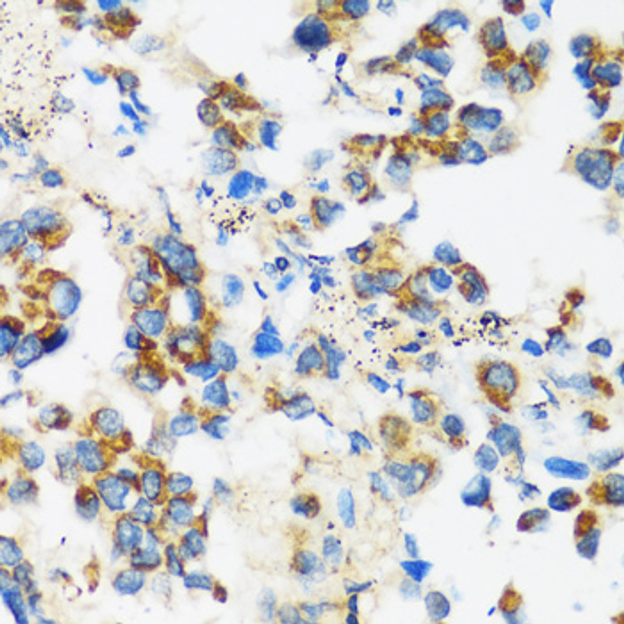 Immunohistochemistry of paraffin-embedded Human lung cancer using APOBEC3F Polyclonal Antibody at dilution of  1:100 (40x lens).