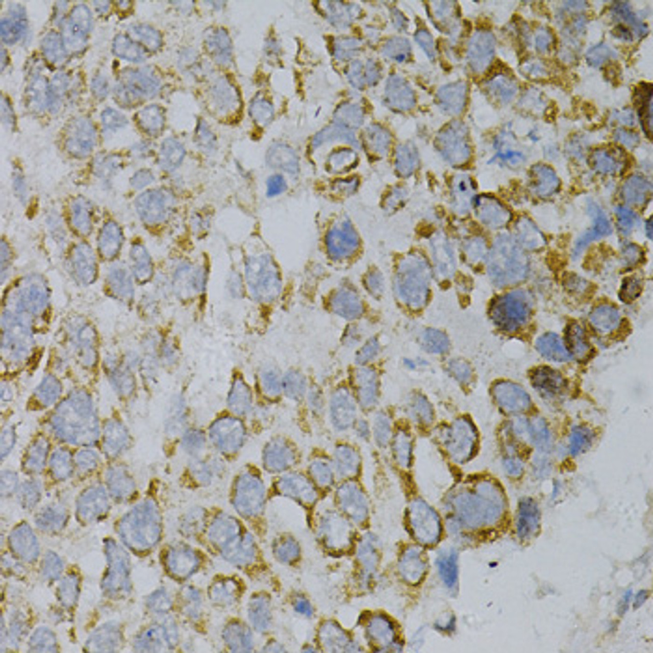 Immunohistochemistry of paraffin-embedded Human esophageal cancer using GNAO1 Polyclonal Antibody at dilution of  1:100 (40x lens).