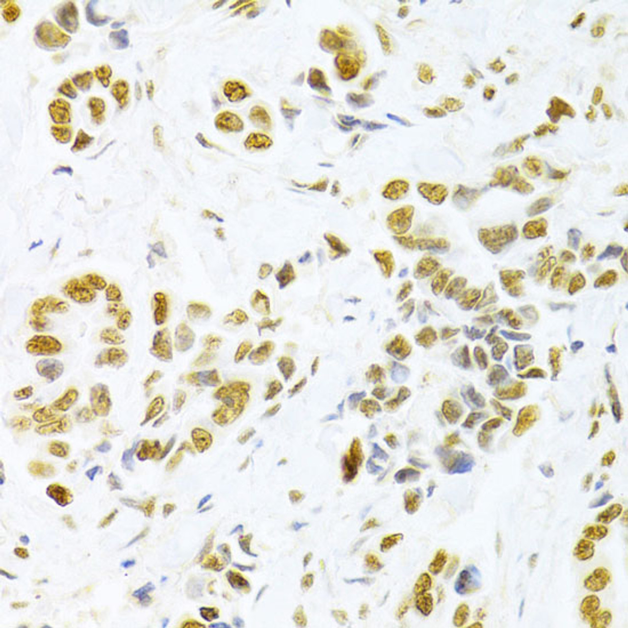 Immunohistochemistry of paraffin-embedded Human breast cancer using HMGB1 Polyclonal Antibody at dilution of  1:100 (40x lens).