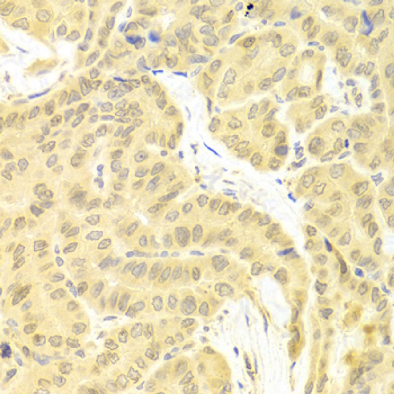 Immunohistochemistry of paraffin-embedded Human thyroid cancer using CFLAR Polyclonal Antibody at dilution of  1:100 (40x lens).