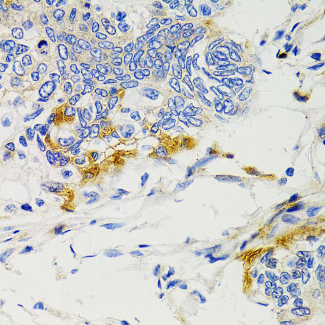 Immunohistochemistry of paraffin-embedded Human gastric cancer using PTPN11 Polyclonal Antibody at dilution of  1:100 (40x lens).