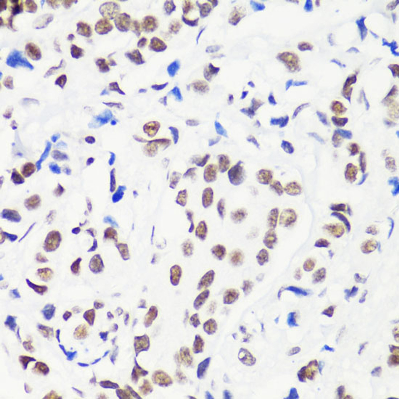 Immunohistochemistry of paraffin-embedded Human breast cancer using MonoMethyl-Histone H3-R8 Polyclonal Antibody at dilution of  1:100 (40x lens).