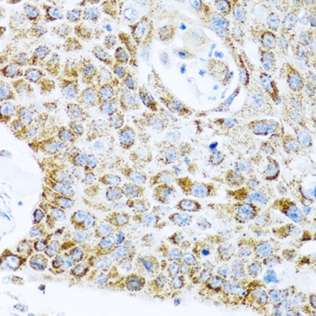 Immunohistochemistry of paraffin-embedded Human lung cancer using LRPPRC Polyclonal Antibody at dilution of  1:100 (40x lens).