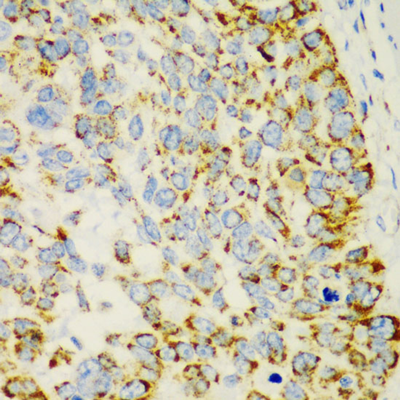 Immunohistochemistry of paraffin-embedded Human esophageal cancer using CHIA Polyclonal Antibody at dilution of  1:100 (40x lens).