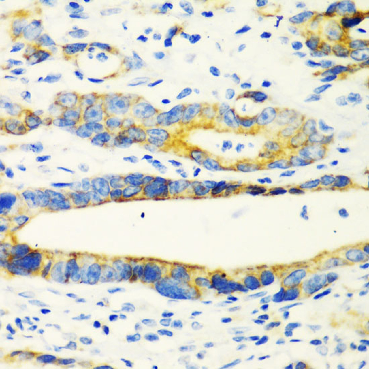 Immunohistochemistry of paraffin-embedded Human gastric cancer using CHIA Polyclonal Antibody at dilution of  1:100 (40x lens).