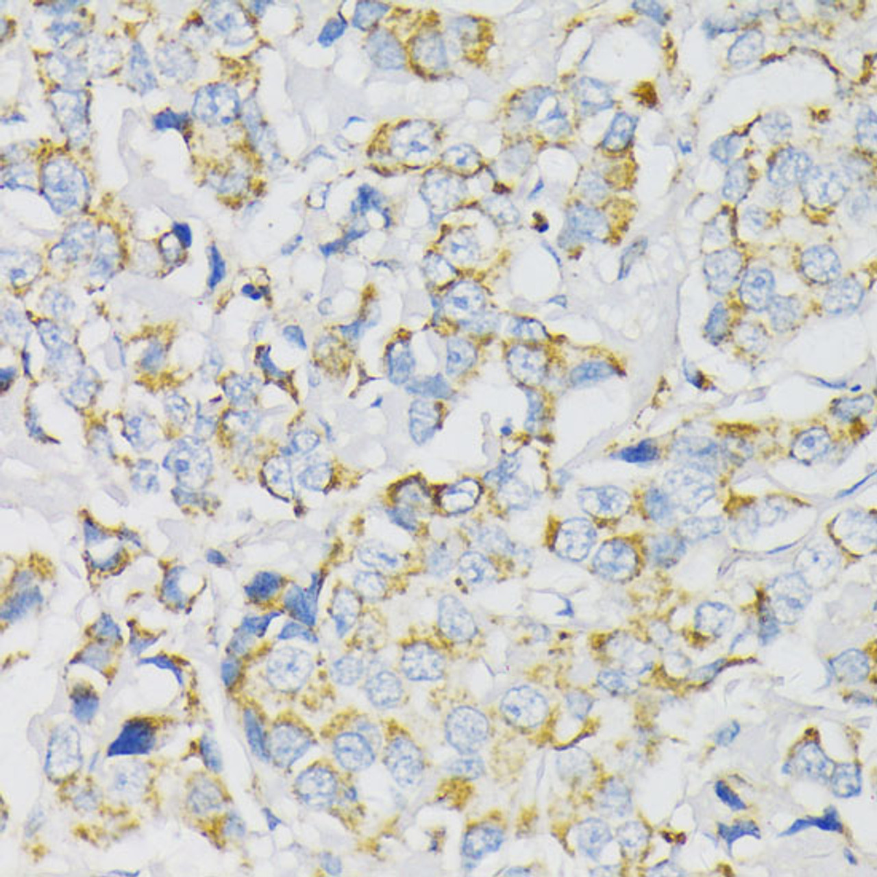Immunohistochemistry of paraffin-embedded Human breast cancer using ATP5J Polyclonal Antibody at dilution of  1:100 (40x lens).