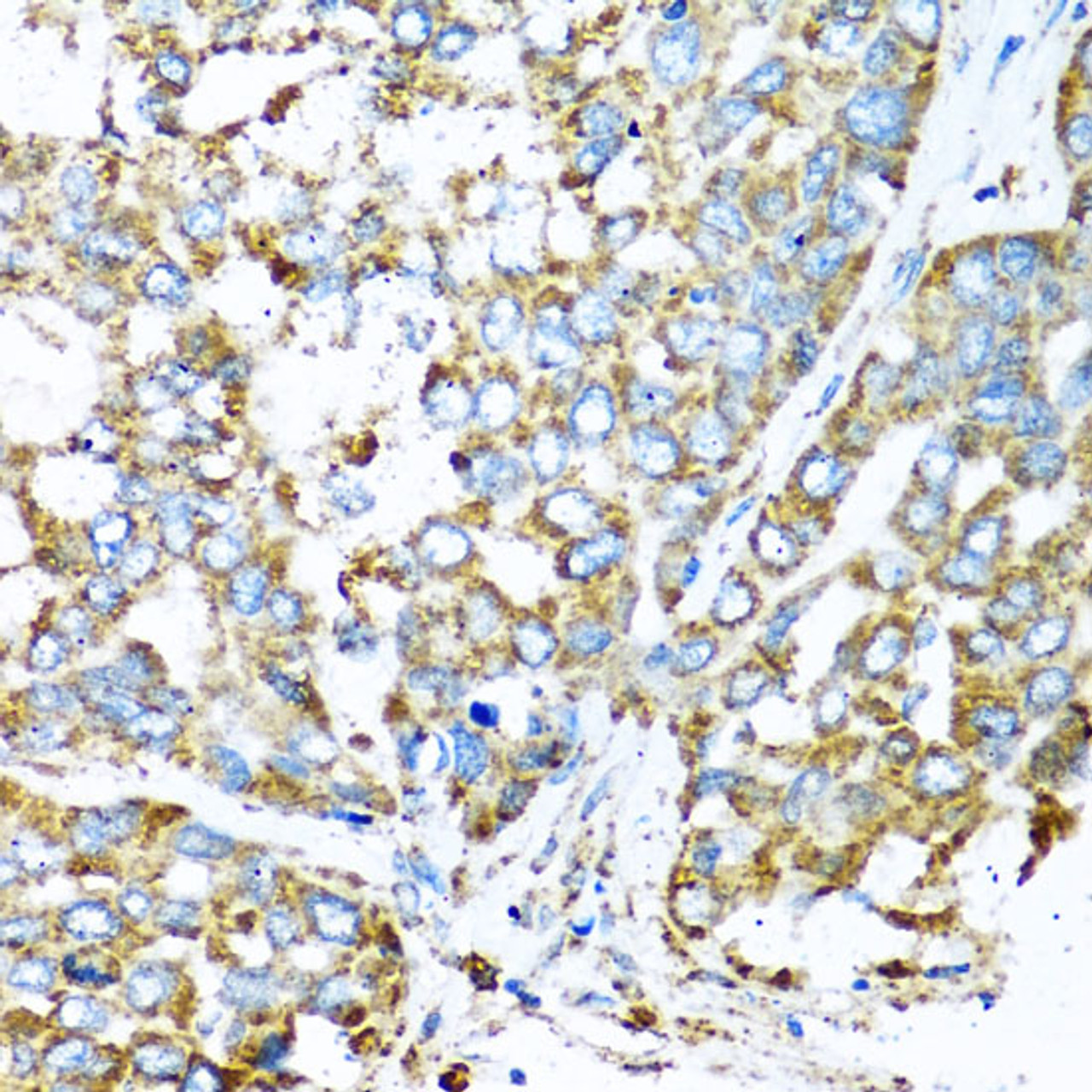 Immunohistochemistry of paraffin-embedded Human liver cancer using COX6A1 Polyclonal Antibody at dilution of  1:100 (40x lens).