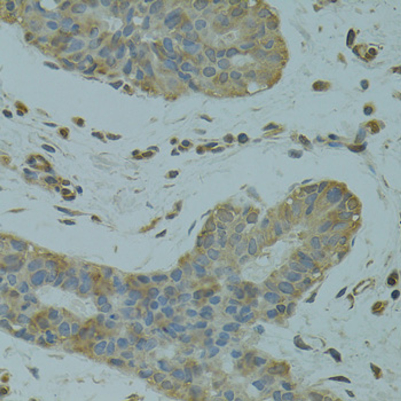 Immunohistochemistry of paraffin-embedded Human breast cancer using DGKQ Polyclonal Antibody at dilution of  1:100 (40x lens).