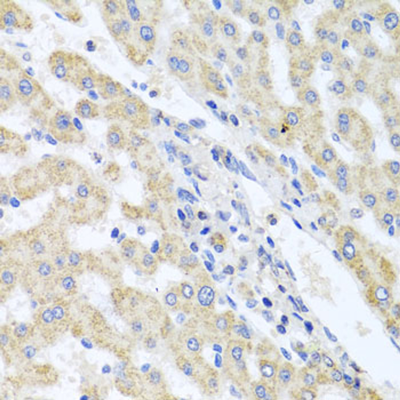 Immunohistochemistry of paraffin-embedded Human liver damage using ITPKB Polyclonal Antibody at dilution of  1:100 (40x lens).