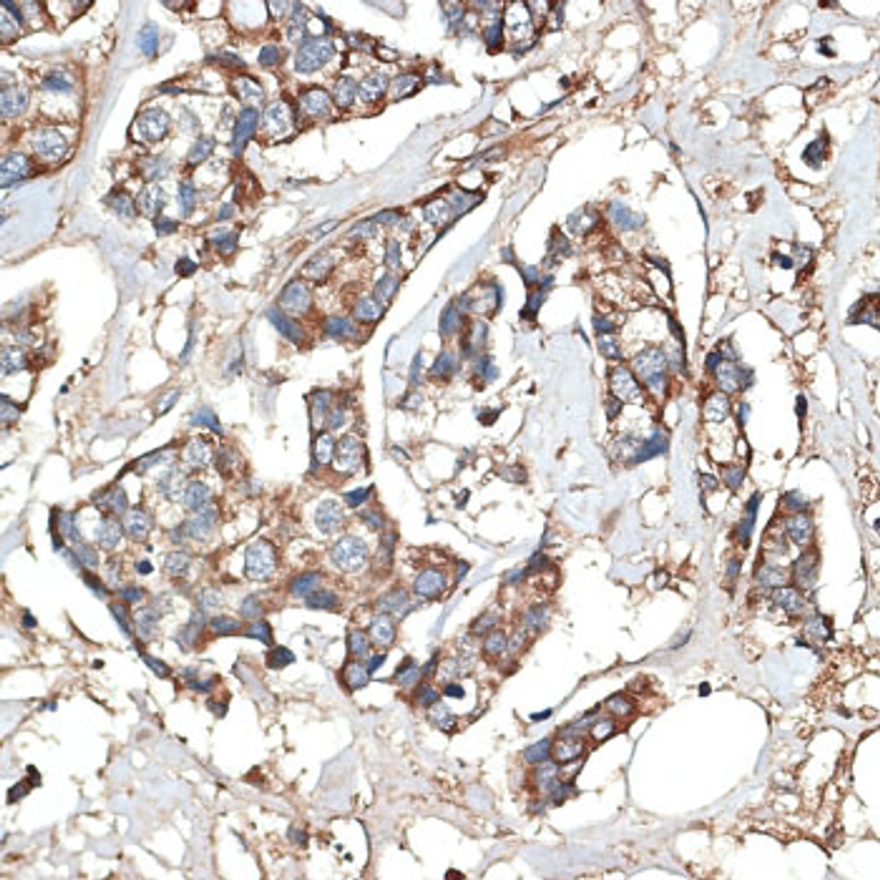 Immunohistochemistry of paraffin-embedded Human mammary cancer using KRT81 Polyclonal Antibody at dilution of  1:100 (40x lens).