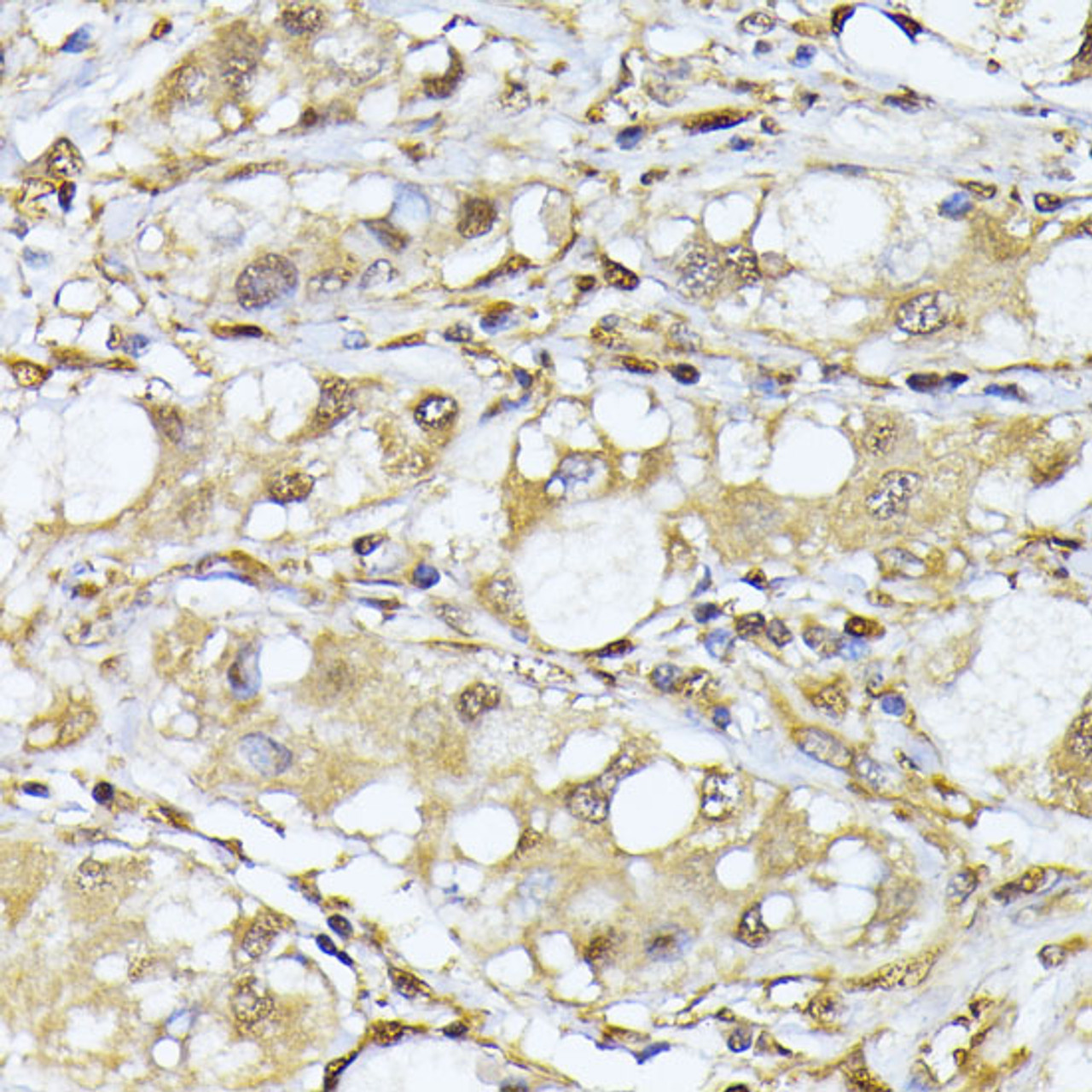 Immunohistochemistry of paraffin-embedded Human liver cancer using PSMA7 Polyclonal Antibody at dilution of  1:100 (40x lens).