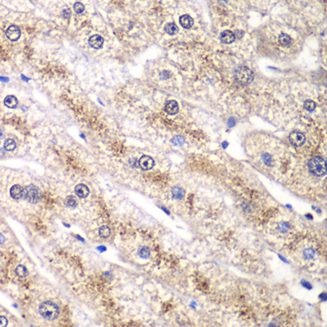 Immunohistochemistry of paraffin-embedded Human liver damage using RALB Polyclonal Antibody at dilution of  1:100 (40x lens).