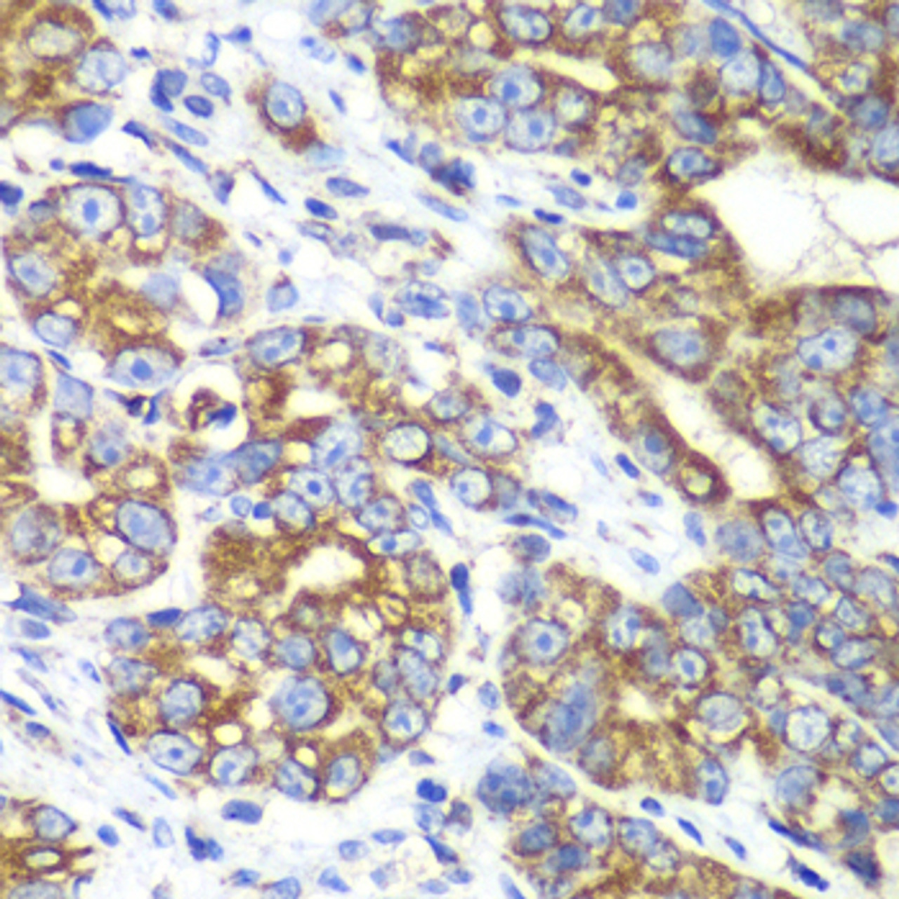 Immunohistochemistry of paraffin-embedded Human gastric cancer using RALB Polyclonal Antibody at dilution of  1:100 (40x lens).