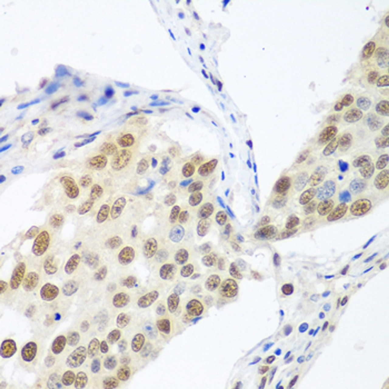 Immunohistochemistry of paraffin-embedded Human lung cancer using BCAS2 Polyclonal Antibody at dilution of  1:100 (40x lens).