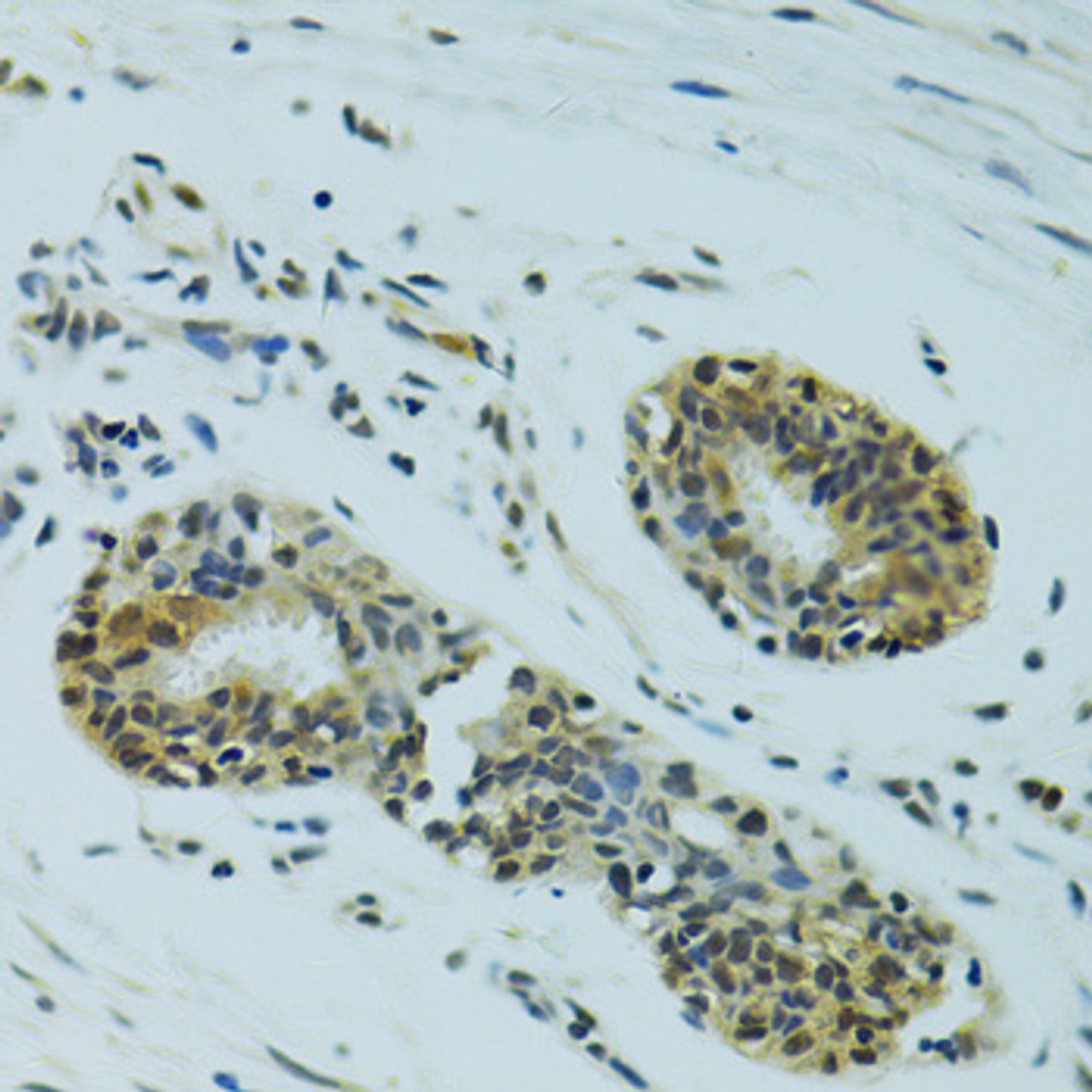 Immunohistochemistry of paraffin-embedded Human breast cancer using NHEJ1 Polyclonal Antibody at dilution of  1:100 (40x lens).