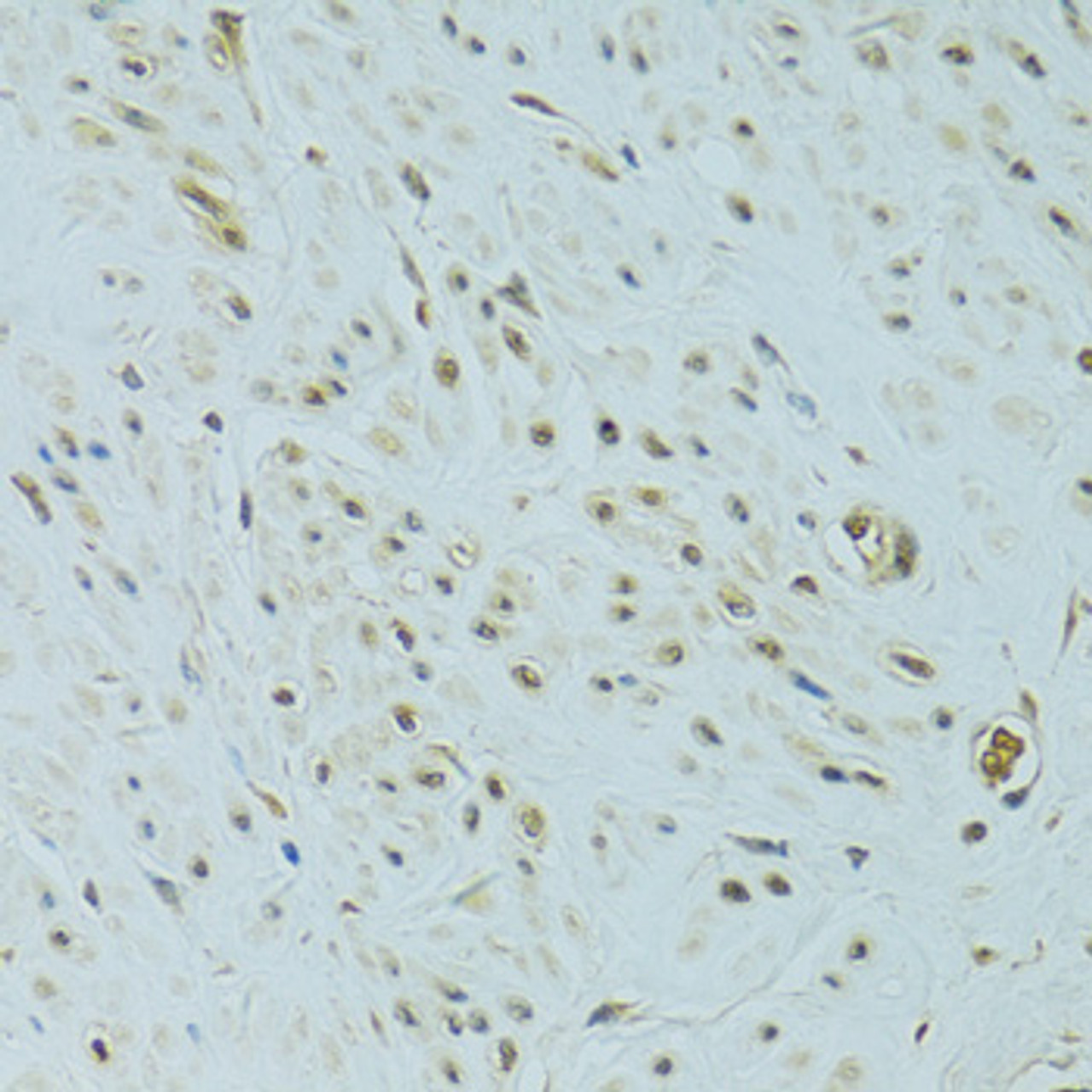 Immunohistochemistry of paraffin-embedded Human uterine cancer using NHEJ1 Polyclonal Antibody at dilution of  1:100 (40x lens).