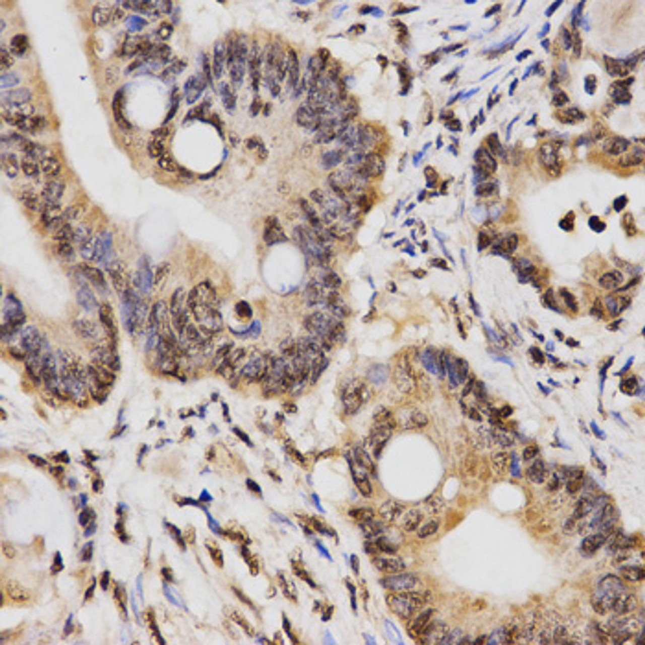 Immunohistochemistry of paraffin-embedded Human rectal cancer using DiMethyl-Histone H3-K14 Polyclonal Antibody at dilution of  1:200 (40x lens).