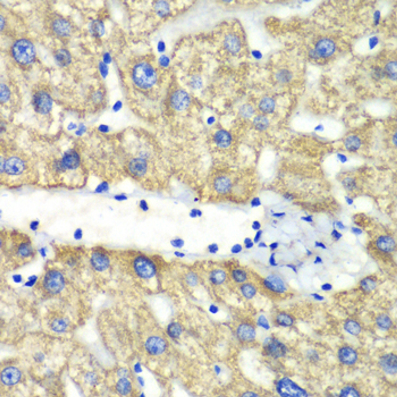 Immunohistochemistry of paraffin-embedded Human liver damage using ABAT Polyclonal Antibody at dilution of  1:100 (40x lens).