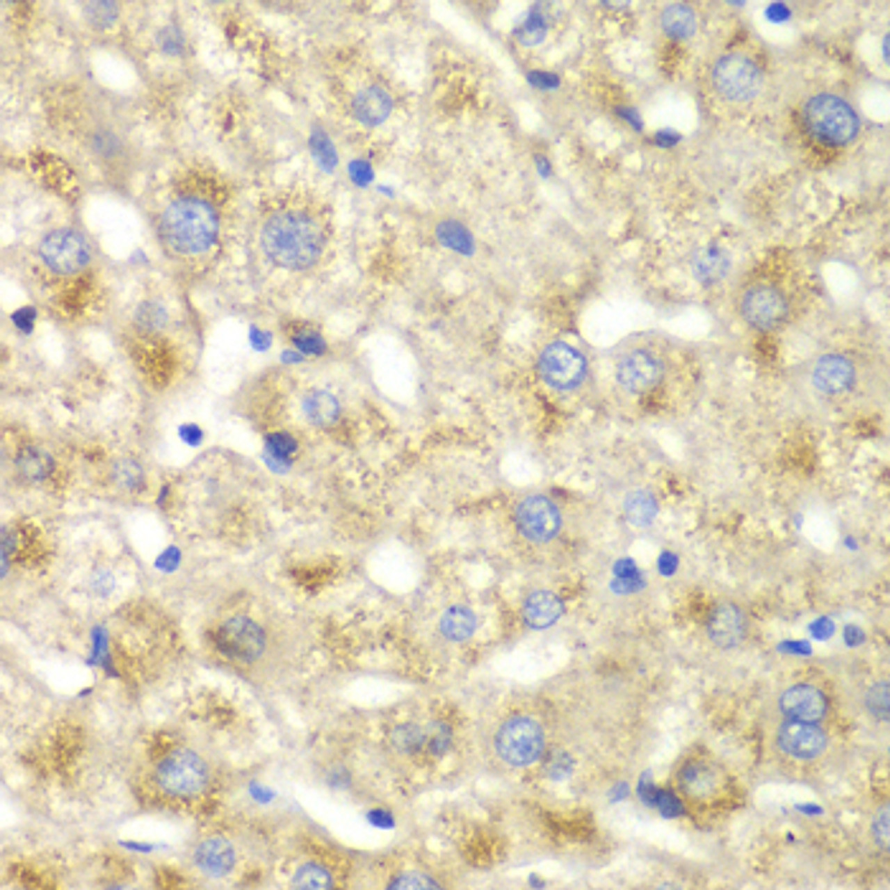 Immunohistochemistry of paraffin-embedded Human liver damage using CALD1 Polyclonal Antibody at dilution of  1:100 (40x lens).