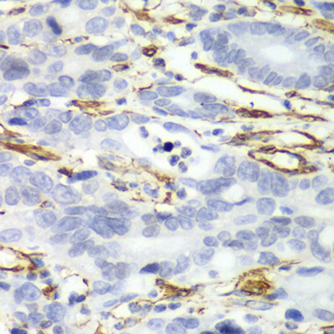 Immunohistochemistry of paraffin-embedded Human gastric cancer using CALD1 Polyclonal Antibody at dilution of  1:100 (40x lens).
