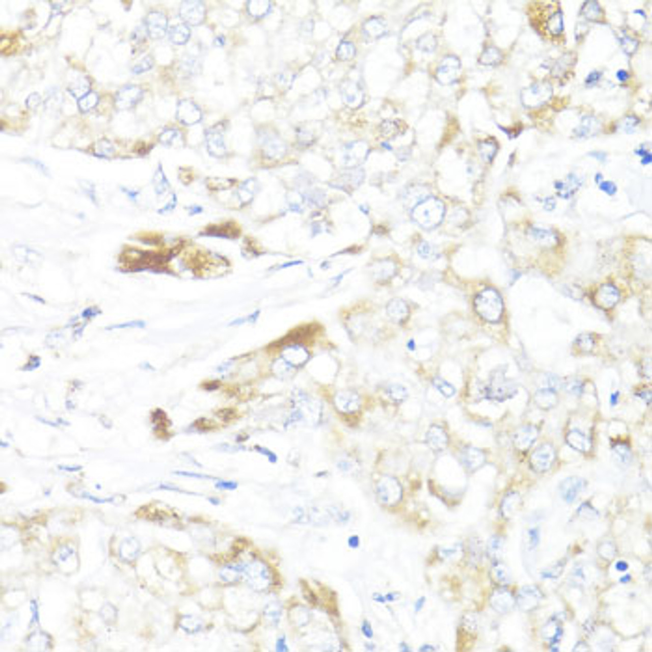 Immunohistochemistry of paraffin-embedded Human liver cancer using HSD17B10 Polyclonal Antibody at dilution of  1:100 (40x lens).