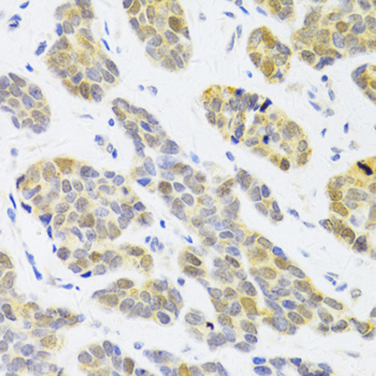 Immunohistochemistry of paraffin-embedded Human breast cancer using RFC4 Polyclonal Antibody at dilution of  1:100 (40x lens).