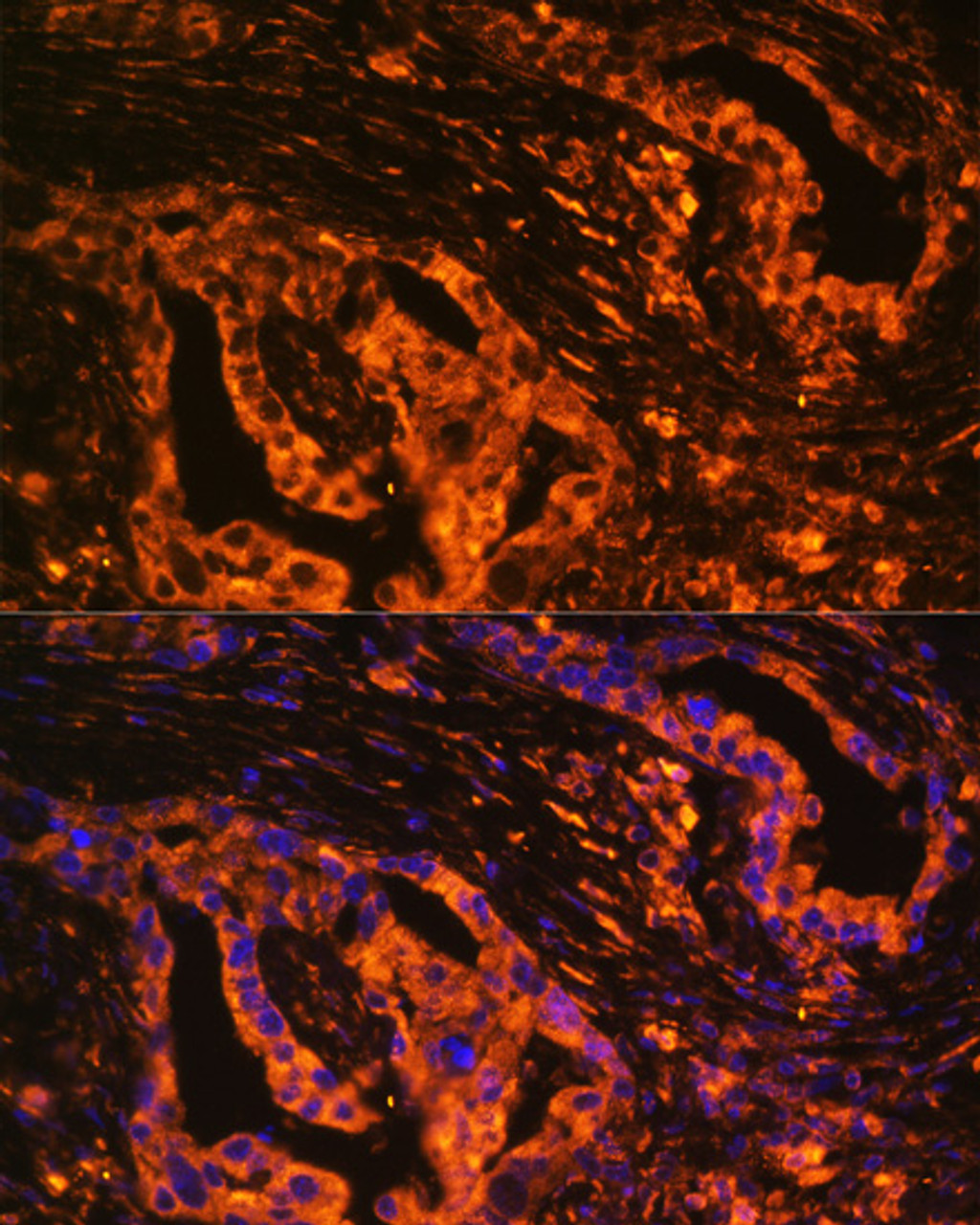 Immunofluorescence analysis of Human lung cancer cells using SCNN1A Polyclonal Antibody at dilution of  1:100. Blue: DAPI for nuclear staining.