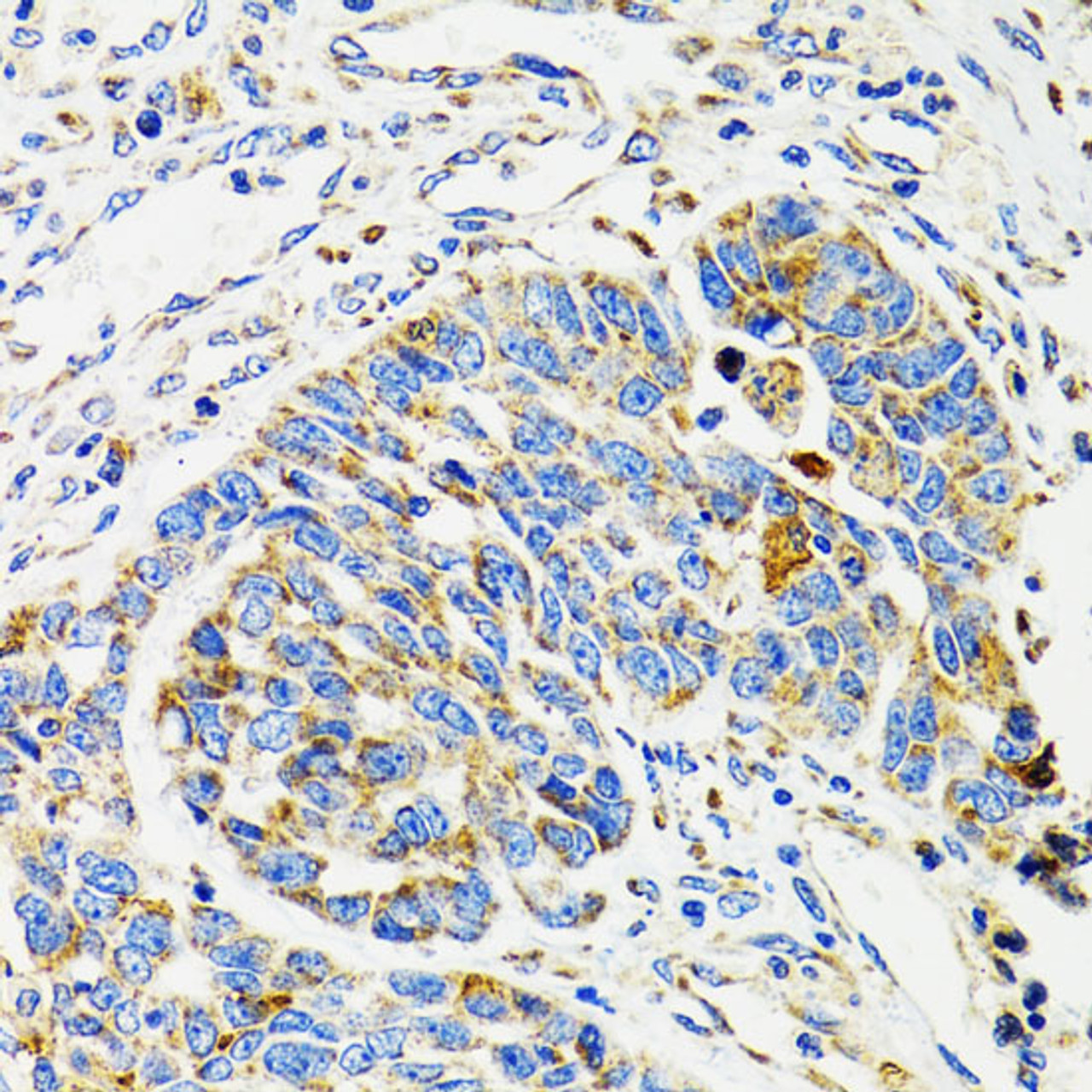 Immunohistochemistry of paraffin-embedded Human esophageal cancer using SH2B1 Polyclonal Antibody at dilution of  1:100 (40x lens).