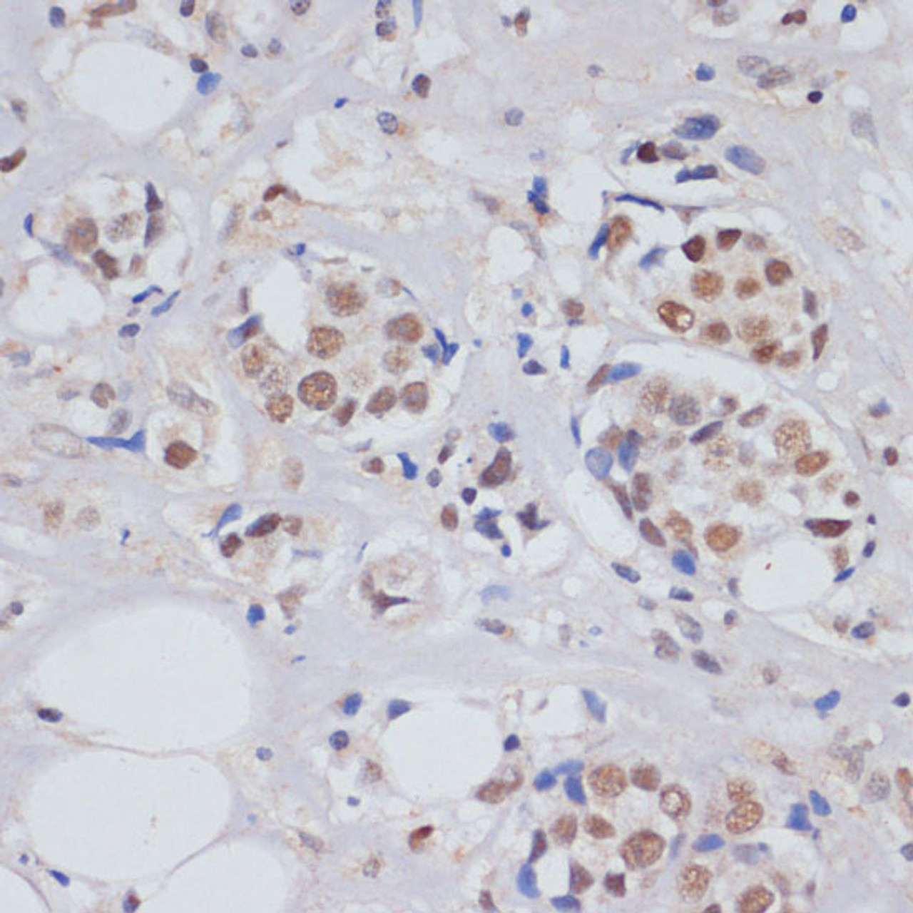 Immunohistochemistry of paraffin-embedded Human breast cancer using SKIV2L2 Polyclonal Antibody at dilution of  1:100 (40x lens).