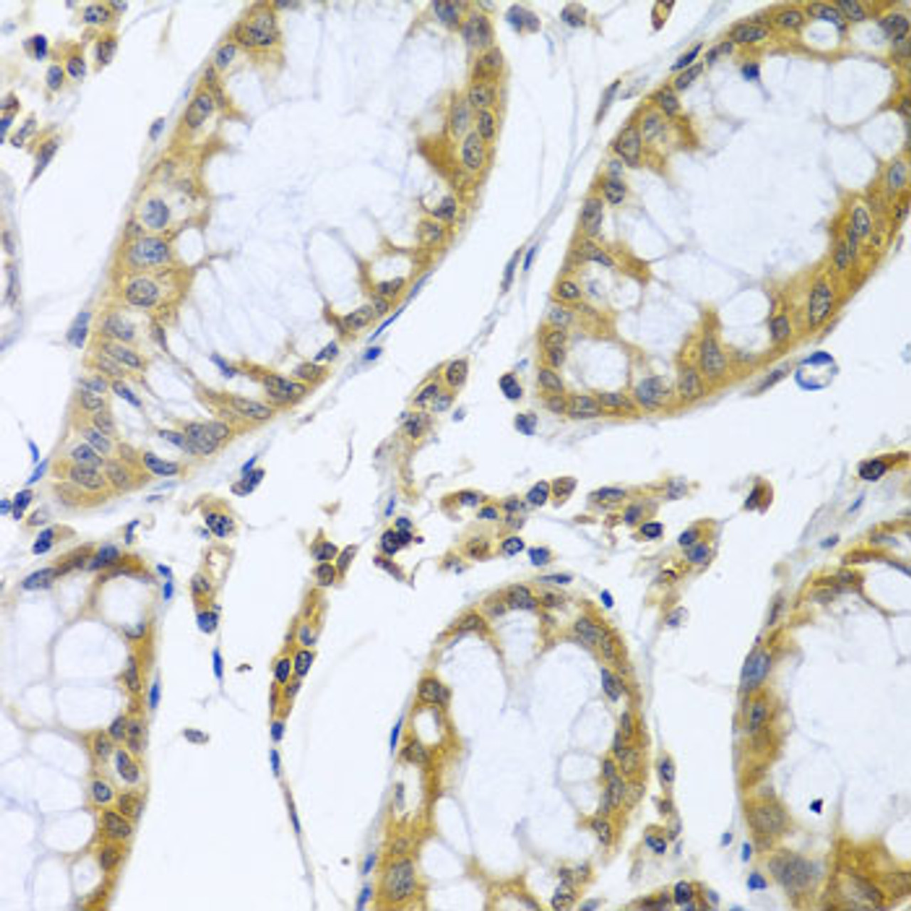 Immunohistochemistry of paraffin-embedded Human colon carcinoma using FBXL5 Polyclonal Antibody at dilution of  1:100 (40x lens).