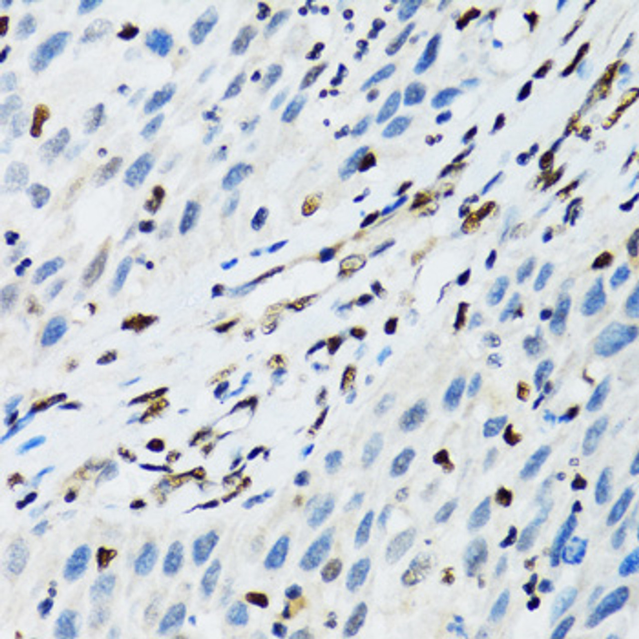 Immunohistochemistry of paraffin-embedded Human lung cancer using FLI1 Polyclonal Antibody at dilution of  1:100 (40x lens).