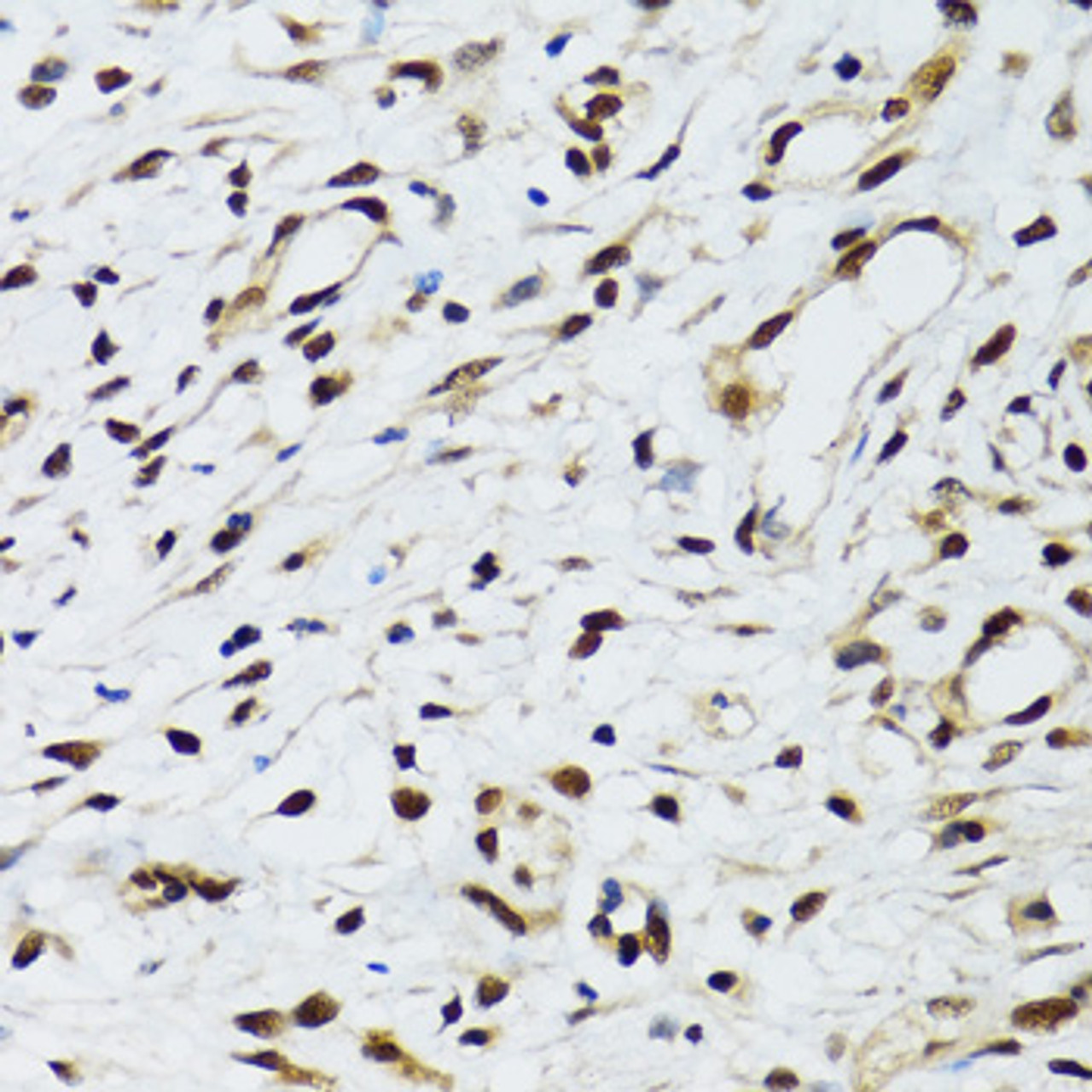Immunohistochemistry of paraffin-embedded Human uterine cancer using FLI1 Polyclonal Antibody at dilution of  1:100 (40x lens).