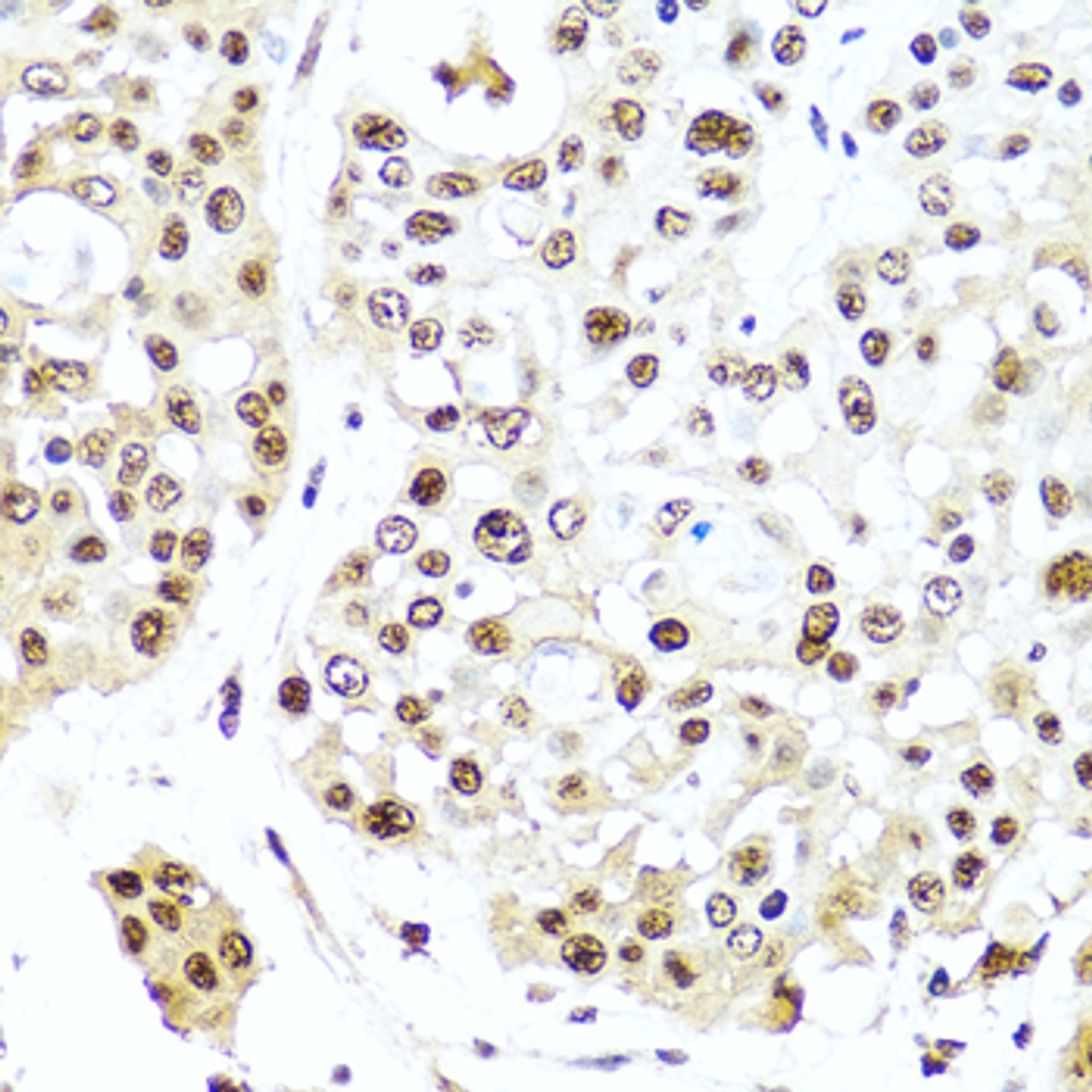 Immunohistochemistry of paraffin-embedded Human colon carcinoma using TET2 Polyclonal Antibody at dilution of  1:100 (40x lens).