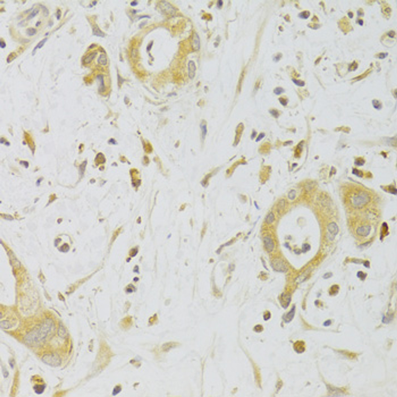 Immunohistochemistry of paraffin-embedded Human liver cancer using Caspase-2 Polyclonal Antibody at dilution of  1:100 (40x lens).