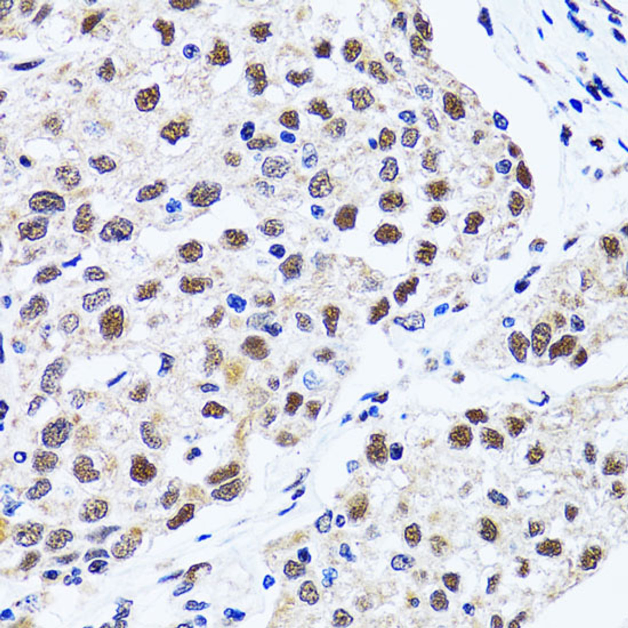 Immunohistochemistry of paraffin-embedded Human lung cancer using 53BP1 Polyclonal Antibody at dilution of  1:100 (40x lens).