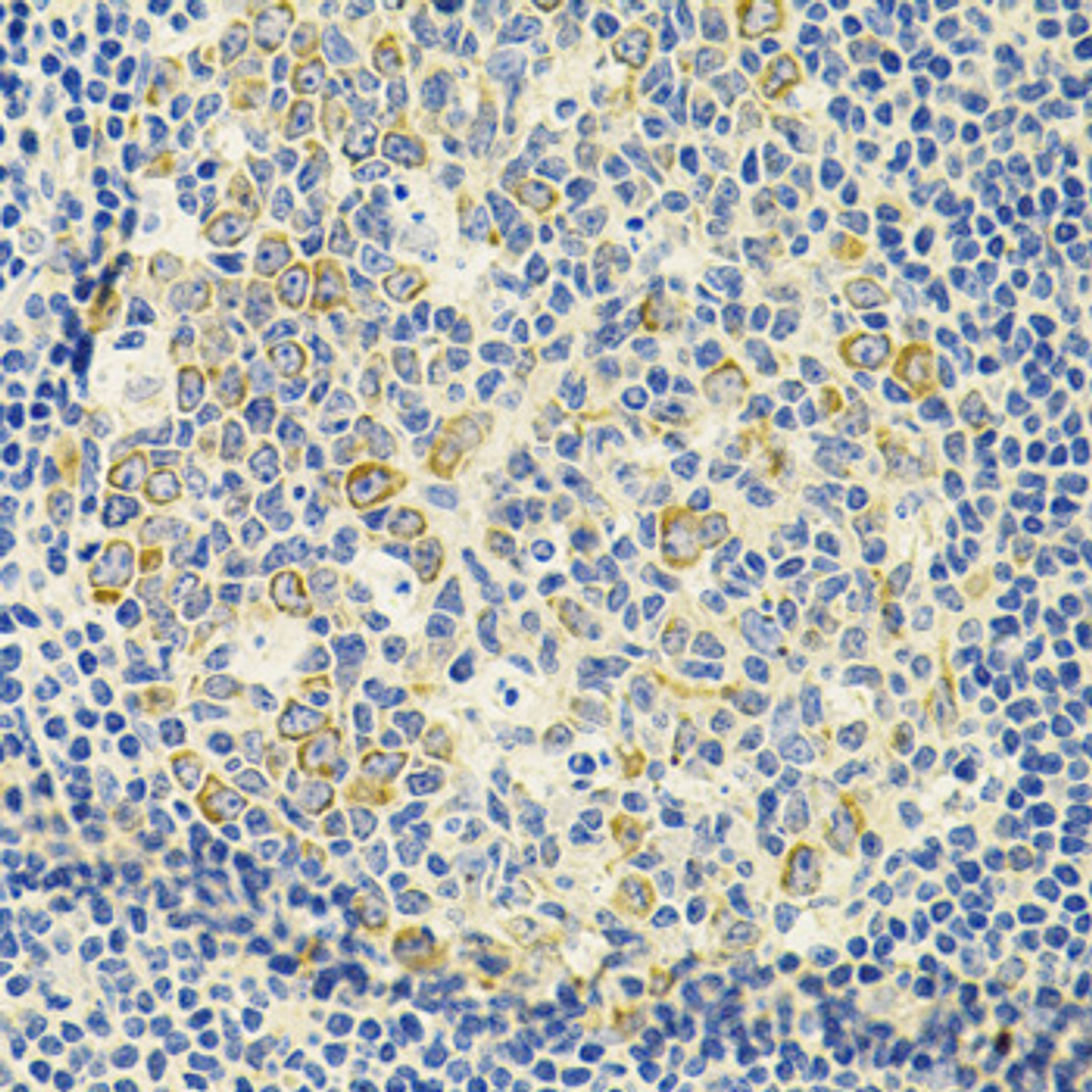 Immunohistochemistry of paraffin-embedded Human amygdalitis using DDX20 Polyclonal Antibody at dilution of  1:100 (40x lens).