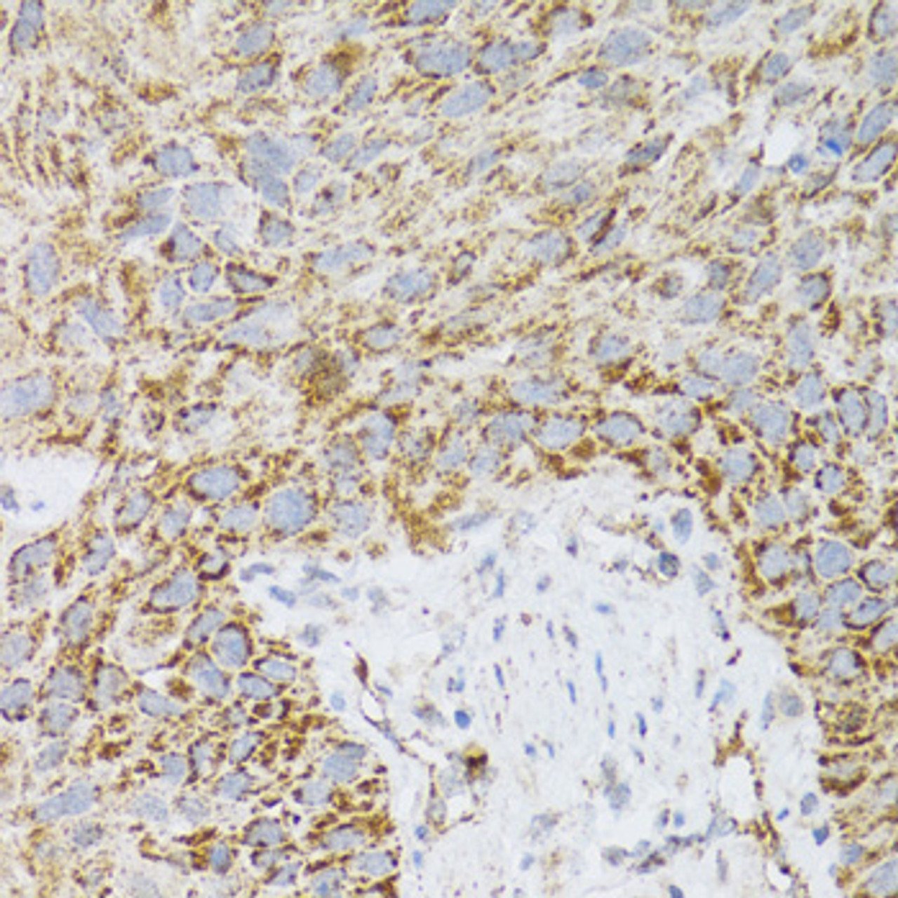 Immunohistochemistry of paraffin-embedded Human lung cancer using PDYN Polyclonal Antibody at dilution of  1:100 (40x lens).