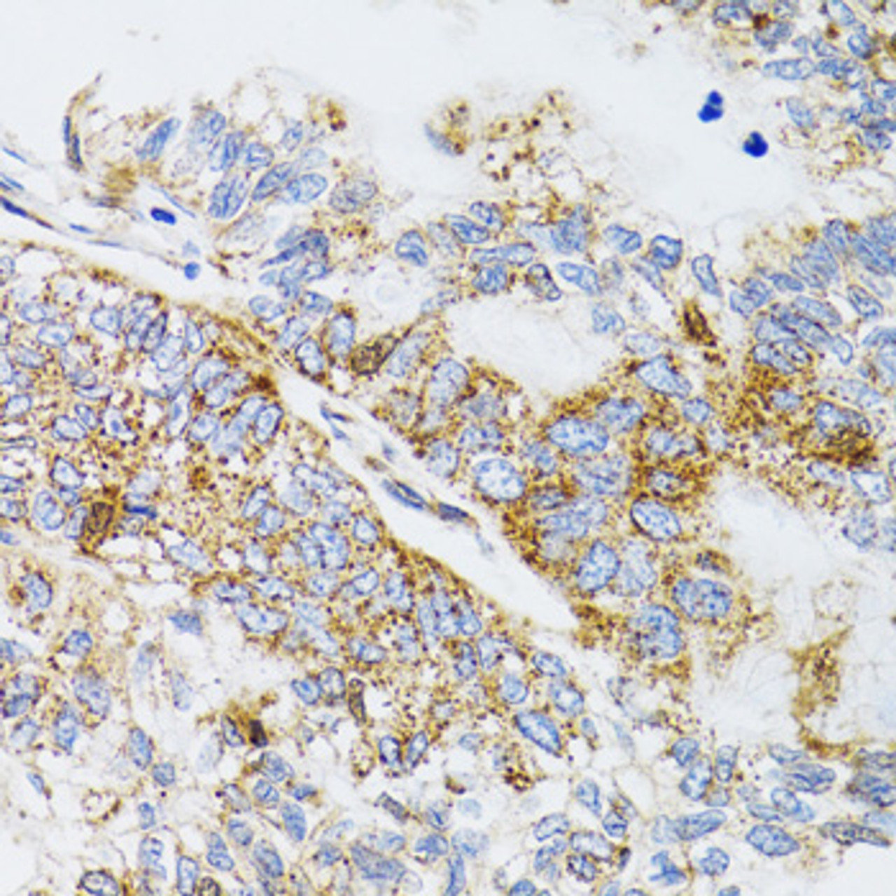 Immunohistochemistry of paraffin-embedded Human gastric cancer using PDYN Polyclonal Antibody at dilution of  1:100 (40x lens).