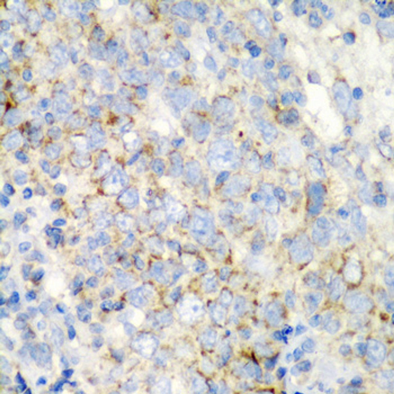 Immunohistochemistry of paraffin-embedded Human esophageal cancer using PRKCQ Polyclonal Antibody at dilution of  1:200 (40x lens).