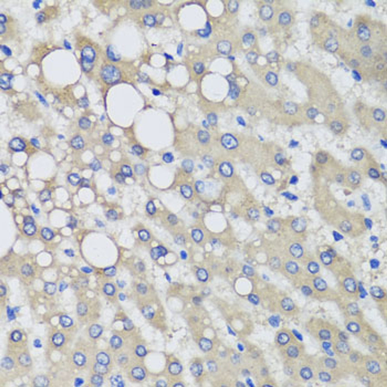 Immunohistochemistry of paraffin-embedded Human liver damage using PRODH Polyclonal Antibody at dilution of  1:100 (40x lens).