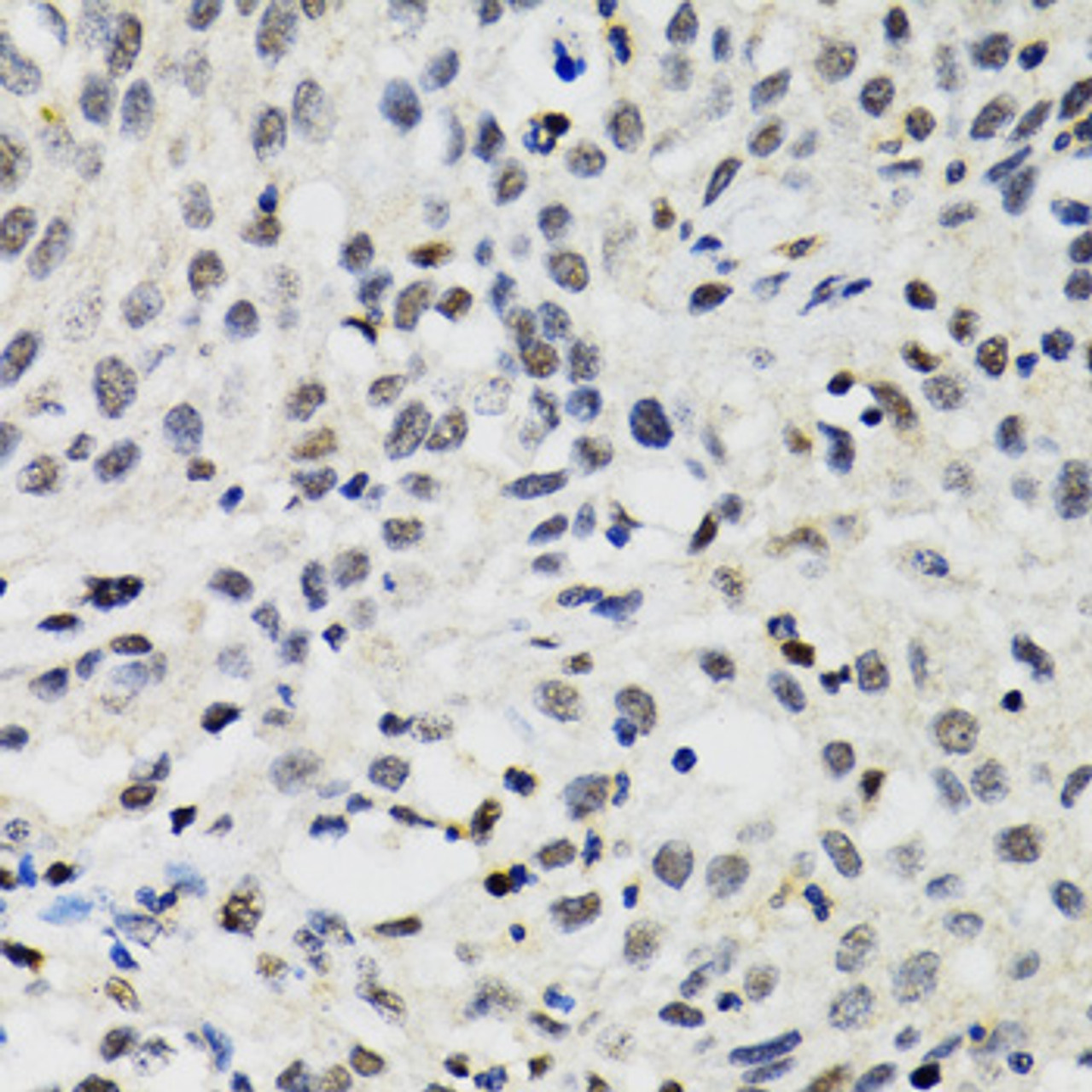 Immunohistochemistry of paraffin-embedded Human lung cancer using SMARCAD1 Polyclonal Antibody at dilution of  1:100 (40x lens).