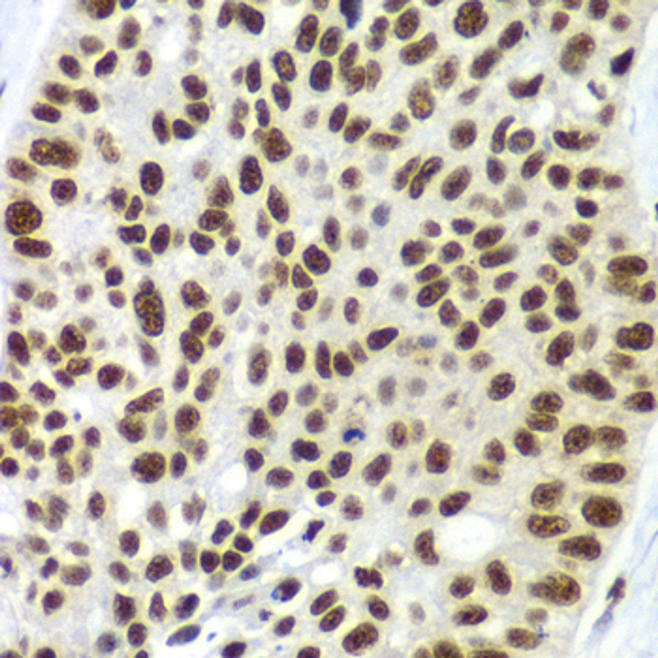 Immunohistochemistry of paraffin-embedded Human lung cancer using SF3B2 Polyclonal Antibody at dilution of  1:100 (40x lens).